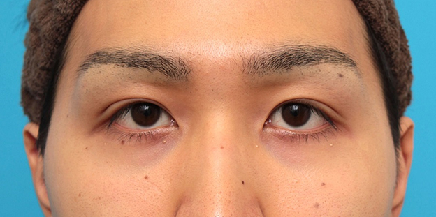 症例写真,眼瞼下垂の症例写真,1ヶ月後,目を開けた状態,mainpic_ganken043e.jpg