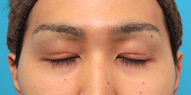 症例写真,眼瞼下垂の症例写真,1ヶ月後,目を閉じた状態,mainpic_ganken043f.jpg