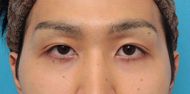 眼瞼下垂（がんけんかすい）,眼瞼下垂の症例写真,3ヶ月後,目を開けた状態,mainpic_ganken043g.jpg