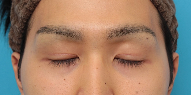 眼瞼下垂（がんけんかすい）,眼瞼下垂の症例写真,3ヶ月後,目を閉じた状態,mainpic_ganken043h.jpg