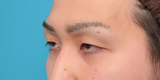 眼瞼下垂（がんけんかすい）,眼瞼下垂の症例写真,施術前,mainpic_ganken043i.jpg