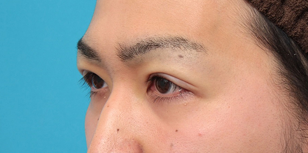 眼瞼下垂（がんけんかすい）,眼瞼下垂の症例写真,施術直後,mainpic_ganken043j.jpg