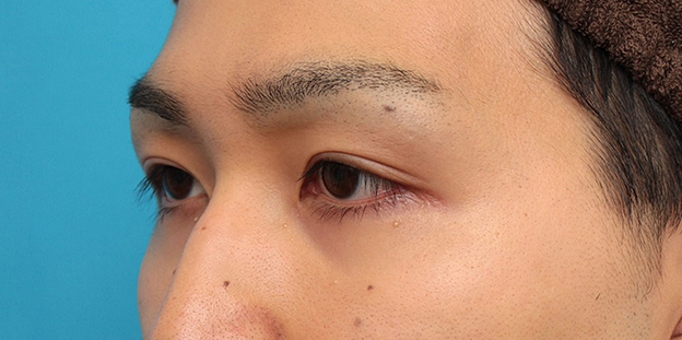眼瞼下垂（がんけんかすい）,眼瞼下垂の症例写真,1ヶ月後,mainpic_ganken043k.jpg