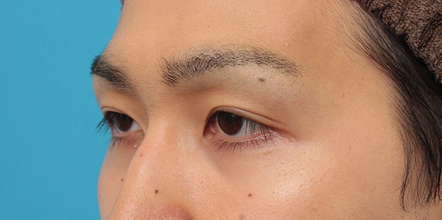 眼瞼下垂（がんけんかすい）,眼瞼下垂の症例写真,3ヶ月後,mainpic_ganken043l.jpg