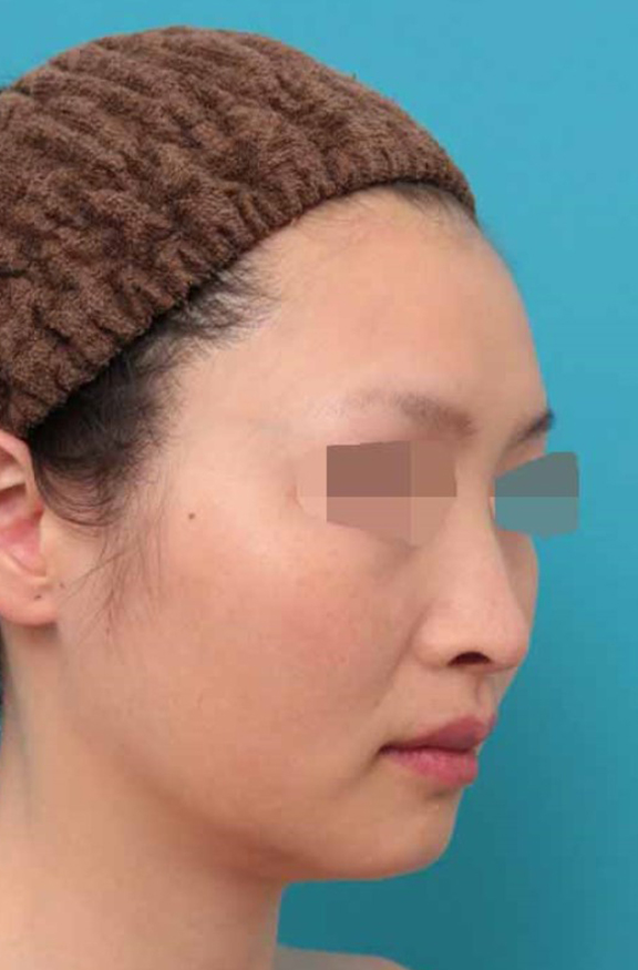 鼻中隔延長（鼻先を大きく下方に延ばす）,鼻中隔延長術の症例写真,After（6ヶ月後）,ba_bichukaku005_b02.jpg