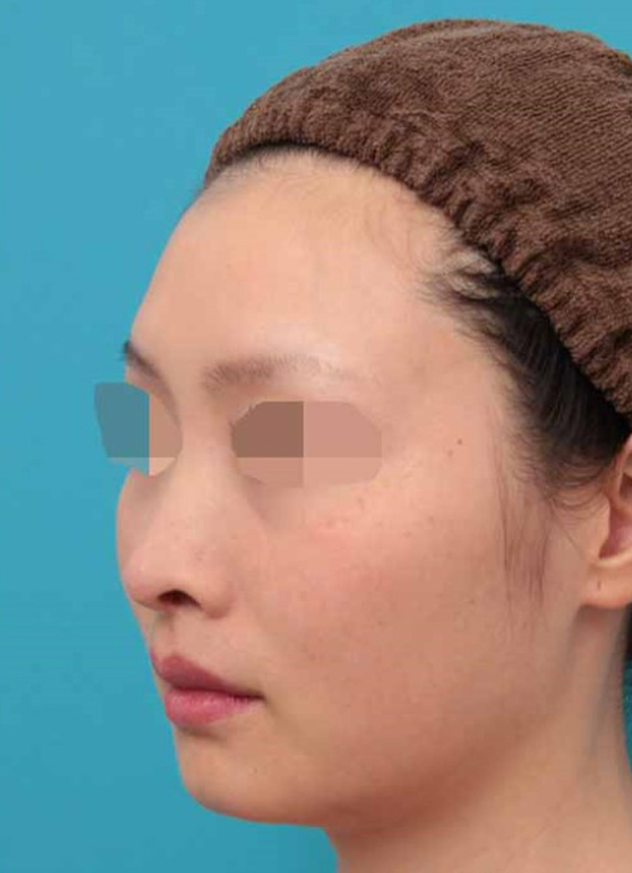 鼻中隔延長（鼻先を大きく下方に延ばす）,鼻中隔延長術の症例写真,After（6ヶ月後）,ba_bichukaku005_b03.jpg