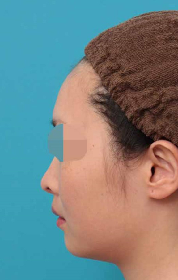 鼻中隔延長（鼻先を大きく下方に延ばす）,鼻中隔延長術の症例写真,After（6ヶ月後）,ba_bichukaku005_b04.jpg