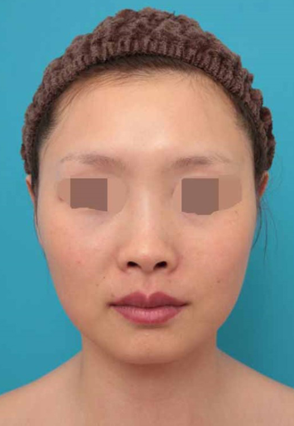 鼻中隔延長（鼻先を大きく下方に延ばす）,鼻中隔延長術の症例写真,Before,ba_bichukaku005_b01.jpg