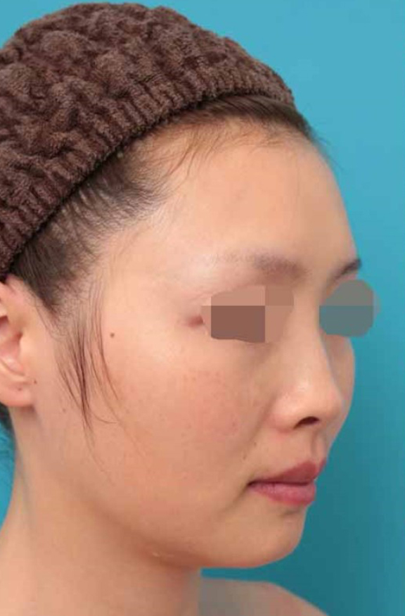 鼻中隔延長（鼻先を大きく下方に延ばす）,鼻中隔延長術の症例写真,Before,ba_bichukaku005_b02.jpg