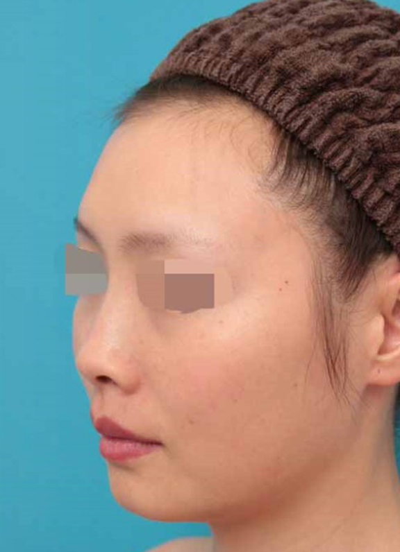 鼻中隔延長（鼻先を大きく下方に延ばす）,鼻中隔延長術の症例写真,Before,ba_bichukaku005_b03.jpg