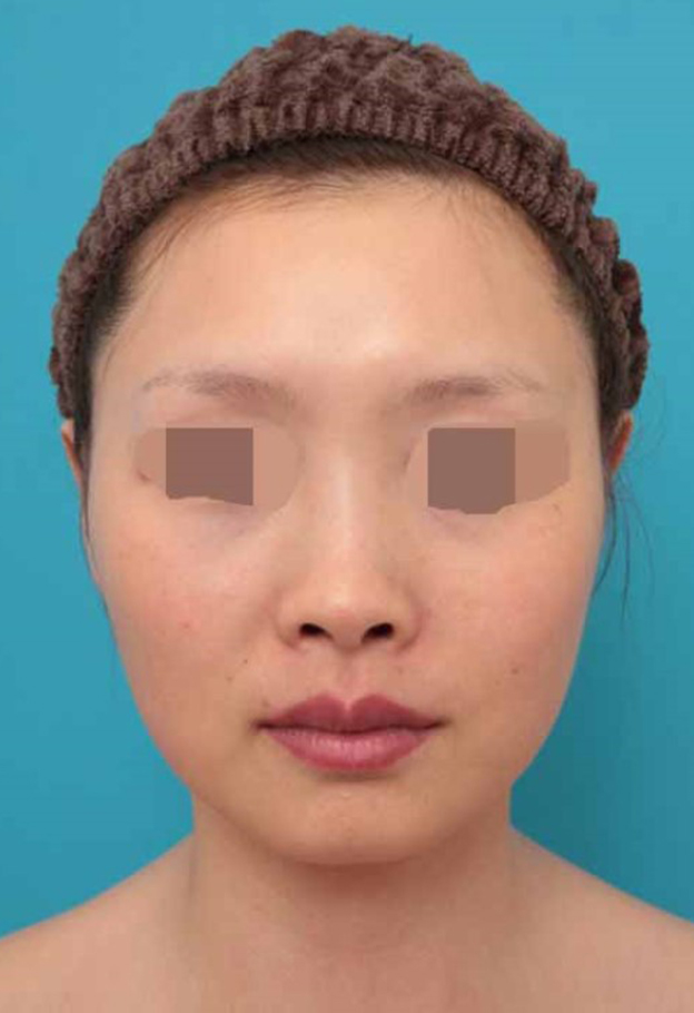 鼻中隔延長（鼻先を大きく下方に延ばす）,鼻中隔延長術の症例写真,施術前,mainpic_bichukaku005a.jpg