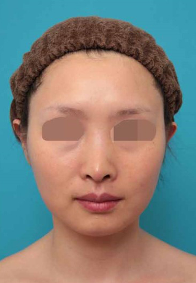 鼻中隔延長（鼻先を大きく下方に延ばす）,鼻中隔延長術の症例写真,1週間後,mainpic_bichukaku005b.jpg