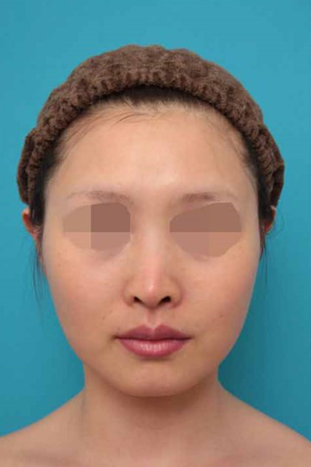 鼻中隔延長（鼻先を大きく下方に延ばす）,鼻中隔延長術の症例写真,1ヶ月後,mainpic_bichukaku005c.jpg