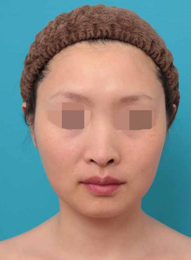 鼻中隔延長（鼻先を大きく下方に延ばす）,鼻中隔延長術の症例写真,6ヶ月後,mainpic_bichukaku005d.jpg