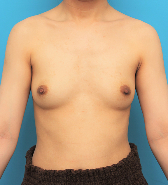 豊胸手術（シリコンプロテーゼ）,乳腺下に265ccシリコンプロテーゼを入れた豊胸手術の症例写真,Before,ba_hokyo036_b01.jpg