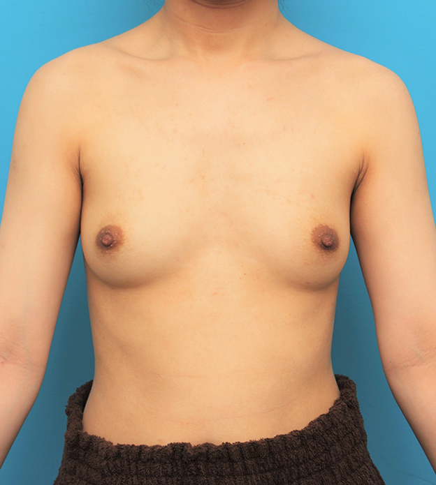 症例写真,乳腺下に265ccシリコンプロテーゼを入れた豊胸手術の症例写真,手術前,mainpic_hokyo036a.jpg