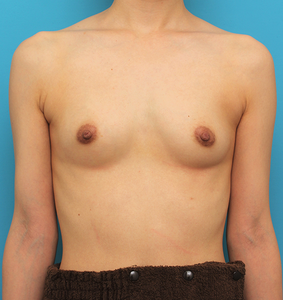 マンマリーヒアル（R）（プチ豊胸術・ヒアルロン酸豊胸術）,片側だけヒアルロン酸豊胸し、バストの左右差を治した症例写真,After（3ヶ月後）,ba_mammary023_a01.jpg