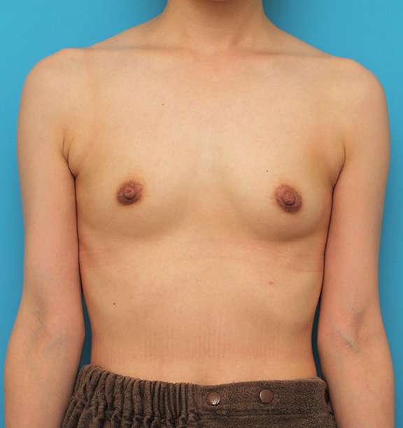 マンマリーヒアル（R）（プチ豊胸術・ヒアルロン酸豊胸術）,片側だけヒアルロン酸豊胸し、バストの左右差を治した症例写真,Before,ba_mammary023_b01.jpg