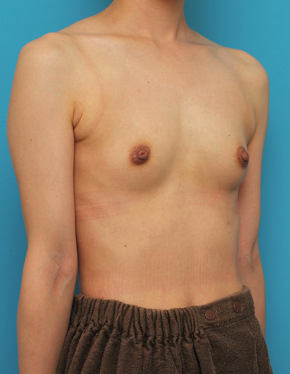 マンマリーヒアル（R）（プチ豊胸術・ヒアルロン酸豊胸術）,片側だけヒアルロン酸豊胸し、バストの左右差を治した症例写真,Before,ba_mammary023_b02.jpg