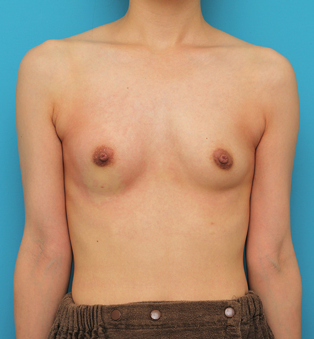マンマリーヒアル（R）（プチ豊胸術・ヒアルロン酸豊胸術）,片側だけヒアルロン酸豊胸し、バストの左右差を治した症例写真,注射直後,mainpic_mammary023b.jpg