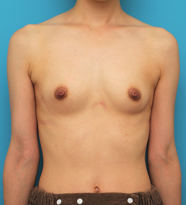 マンマリーヒアル（R）（プチ豊胸術・ヒアルロン酸豊胸術）,片側だけヒアルロン酸豊胸し、バストの左右差を治した症例写真,1週間後,mainpic_mammary023c.jpg
