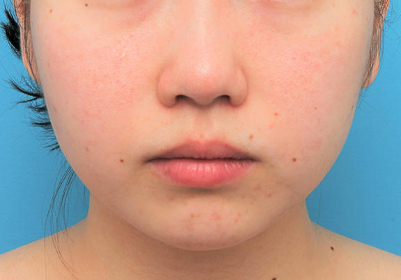 あご注射（ヒアルロン酸）,顎に長期持続型ヒアルロン酸を1本（1cc）注射した20代女性の症例写真,After（3週間後）,ba_agochu017_b01.jpg