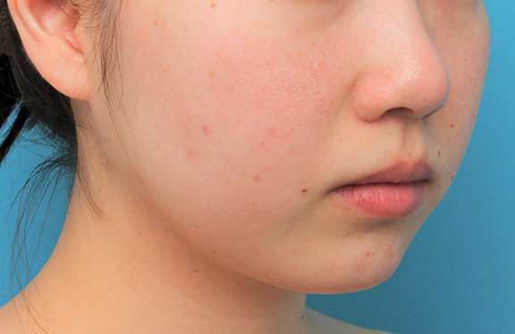 あご注射（ヒアルロン酸）,顎に長期持続型ヒアルロン酸を1本（1cc）注射した20代女性の症例写真,After（3週間後）,ba_agochu017_b02.jpg