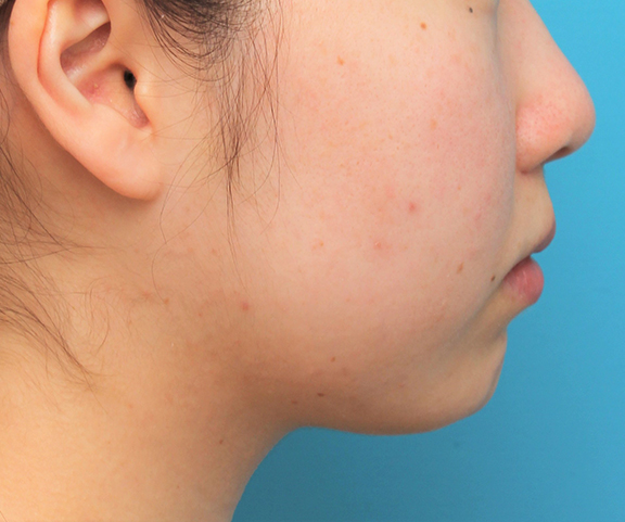 あご注射（ヒアルロン酸）,顎に長期持続型ヒアルロン酸を1本（1cc）注射した20代女性の症例写真,After（3週間後）,ba_agochu017_b03.jpg