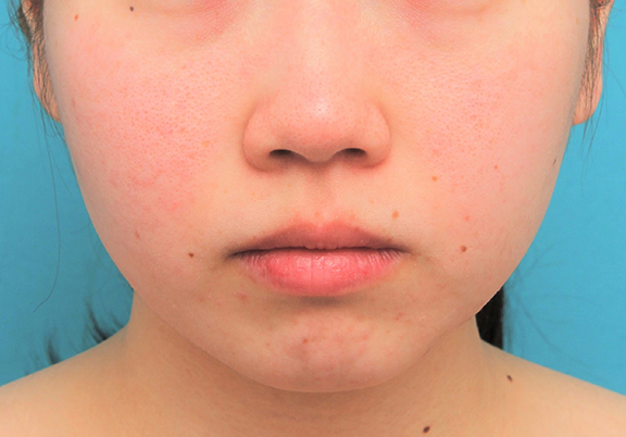 症例写真,顎に長期持続型ヒアルロン酸を1本（1cc）注射した20代女性の症例写真,Before,ba_agochu017_b01.jpg
