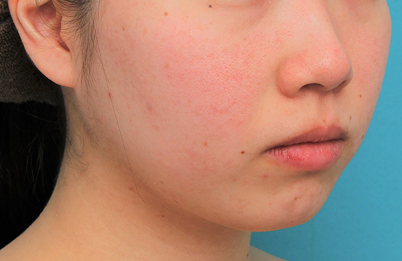 あご注射（ヒアルロン酸）,顎に長期持続型ヒアルロン酸を1本（1cc）注射した20代女性の症例写真,Before,ba_agochu017_b02.jpg