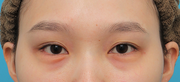 目尻切開,目尻切開＋垂れ目形成（グラマラスライン）を行った20代女性の症例写真,Before,ba_mejiri023_b01.jpg