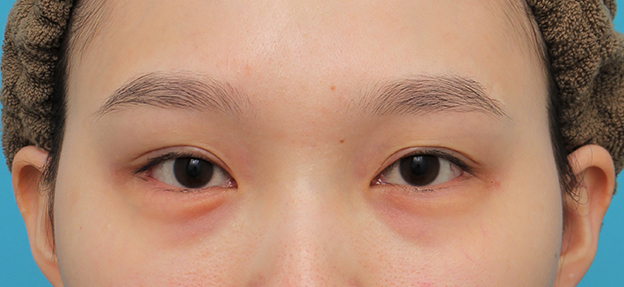 垂れ目（パンダ目）形成（グラマラスライン／下眼瞼下制術）,目尻切開＋垂れ目形成（グラマラスライン）を行った20代女性の症例写真,手術前,mainpic_mejiri023a.jpg