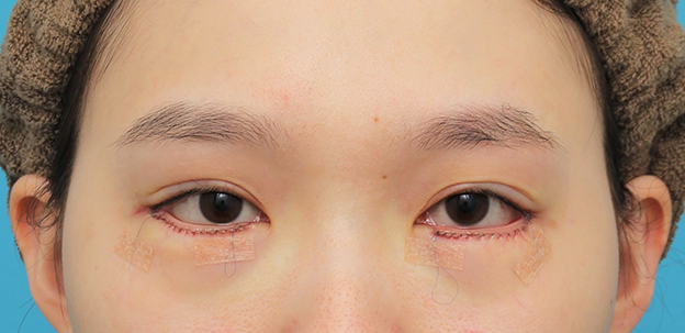垂れ目（パンダ目）形成（グラマラスライン／下眼瞼下制術）,目尻切開＋垂れ目形成（グラマラスライン）を行った20代女性の症例写真,手術直後,mainpic_mejiri023b.jpg