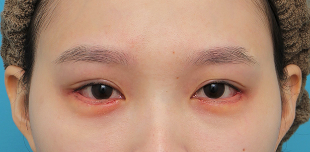垂れ目（パンダ目）形成（グラマラスライン／下眼瞼下制術）,目尻切開＋垂れ目形成（グラマラスライン）を行った20代女性の症例写真,6日後,mainpic_mejiri023c.jpg