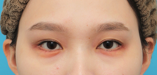 症例写真,目尻切開＋垂れ目形成（グラマラスライン）を行った20代女性の症例写真,3週間後,mainpic_mejiri023d.jpg