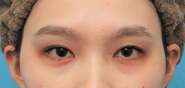 垂れ目（パンダ目）形成（グラマラスライン／下眼瞼下制術）,目尻切開＋垂れ目形成（グラマラスライン）を行った20代女性の症例写真,2ヶ月後,mainpic_mejiri023e.jpg