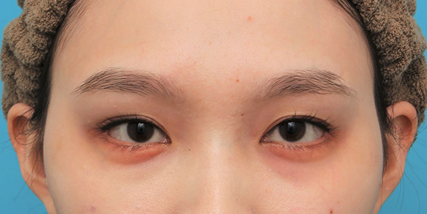 症例写真,目尻切開＋垂れ目形成（グラマラスライン）を行った20代女性の症例写真,6ヶ月後,mainpic_mejiri023f.jpg
