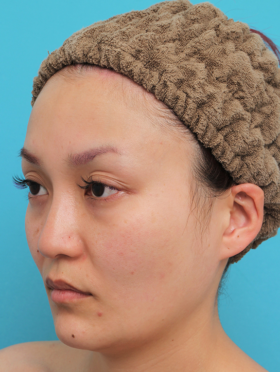 ボツリヌストキシン注射（エラ、プチ小顔術）,頬骨削り＋エラボツリヌストキシン注射で輪郭を整えた30代女性の症例画像,After（4ヶ月後）,ba_hohobone001_b02.jpg