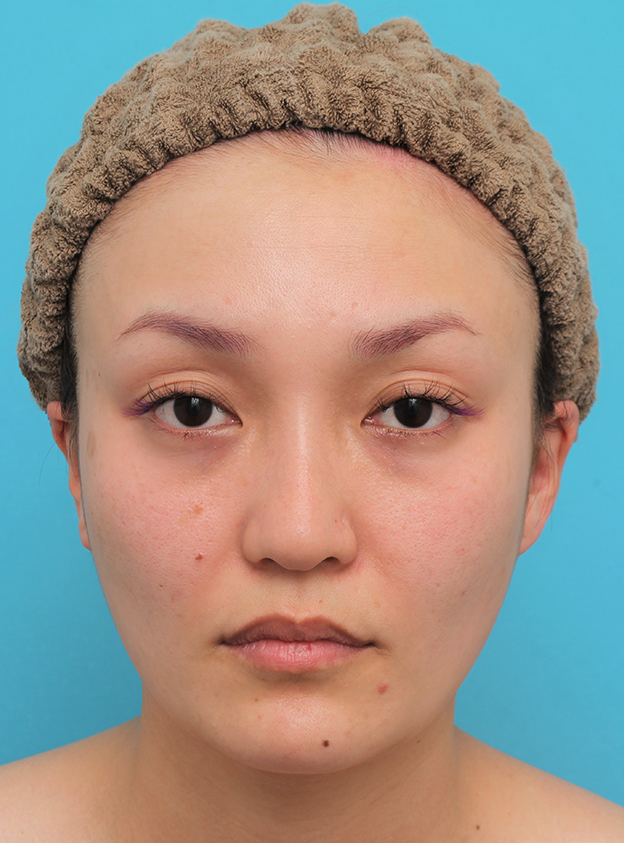 ボツリヌストキシン注射（エラ、プチ小顔術）,頬骨削り＋エラボツリヌストキシン注射で輪郭を整えた30代女性の症例画像,4ヶ月後,mainpic_hohobone001e.jpg