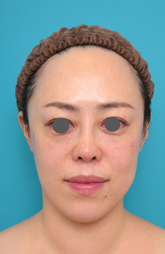 耳介軟骨移植（鼻先を出す）,鼻プロテーゼ、耳介軟骨移植の症例写真,After（メイクなし）<br/>
（1ヶ月後）,ba_ryubi1058_b01.jpg