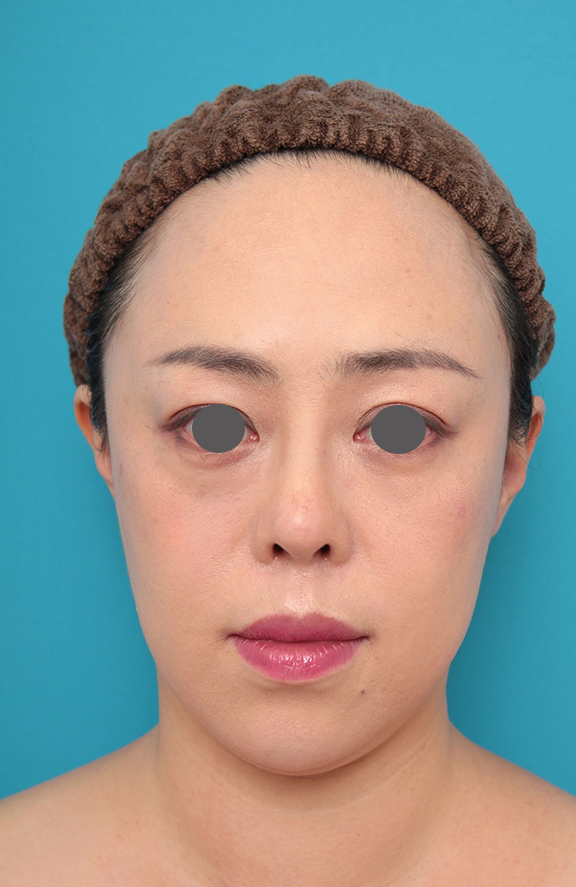 隆鼻術（シリコンプロテーゼ）,鼻プロテーゼ、耳介軟骨移植の症例写真,After（メイクあり）<br/>
（1ヶ月後）,
