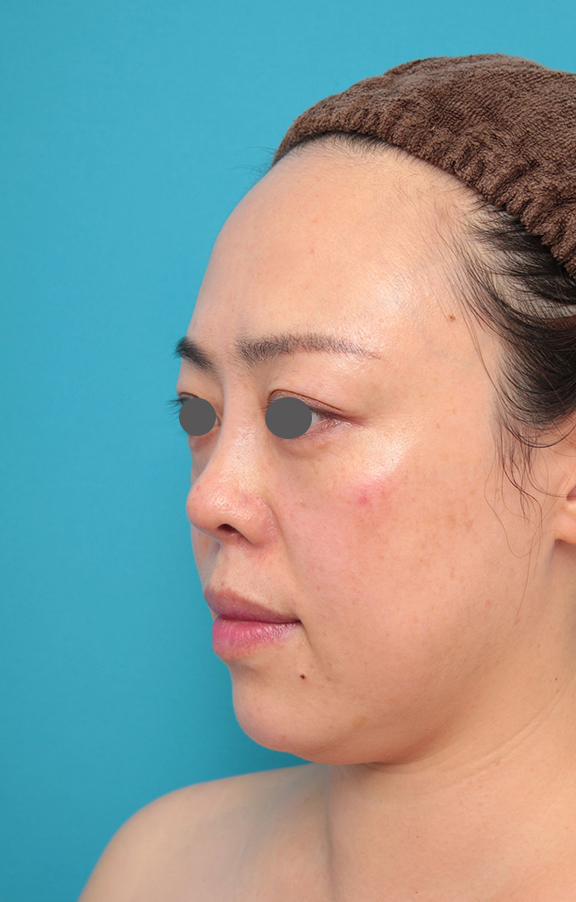 隆鼻術（シリコンプロテーゼ）,鼻プロテーゼ、耳介軟骨移植の症例写真,After（メイクなし）<br/>
（1ヶ月後）,ba_ryubi1058_b02.jpg