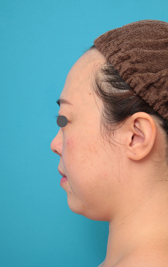 隆鼻術（シリコンプロテーゼ）,鼻プロテーゼ、耳介軟骨移植の症例写真,After（メイクなし）<br/>
（1ヶ月後）,ba_ryubi1058_b03.jpg