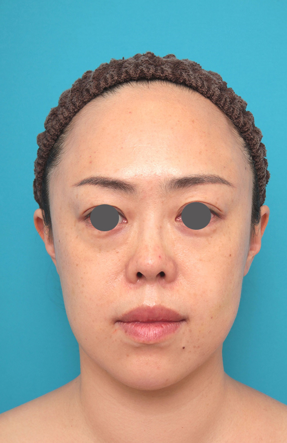 耳介軟骨移植（鼻先を出す）,鼻プロテーゼ、耳介軟骨移植の症例写真,Before,ba_ryubi1058_b01.jpg