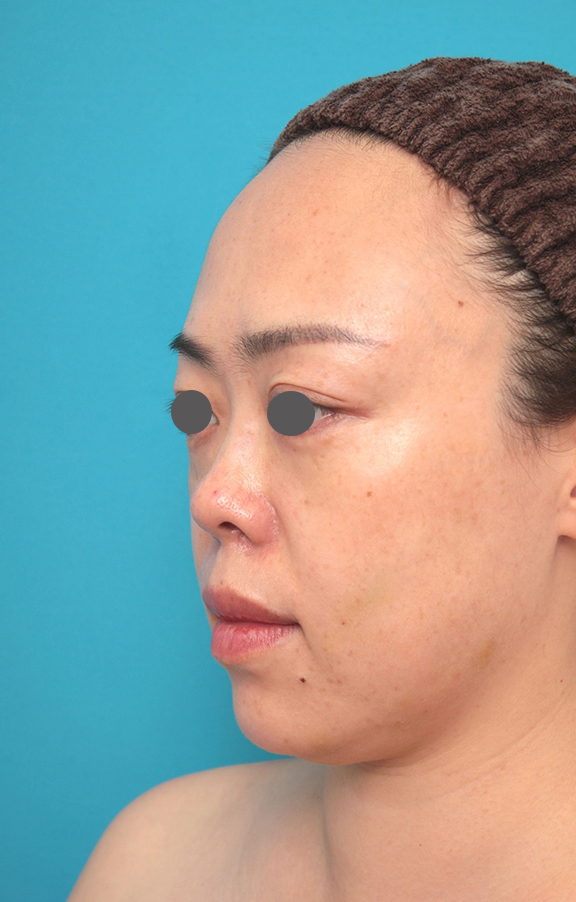 耳介軟骨移植（鼻先を出す）,鼻プロテーゼ、耳介軟骨移植の症例写真,Before,ba_ryubi1058_b02.jpg