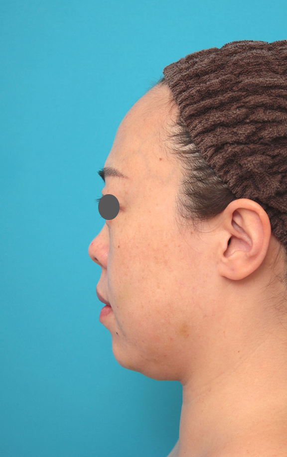隆鼻術（シリコンプロテーゼ）,鼻プロテーゼ、耳介軟骨移植の症例写真,Before,ba_ryubi1058_b03.jpg