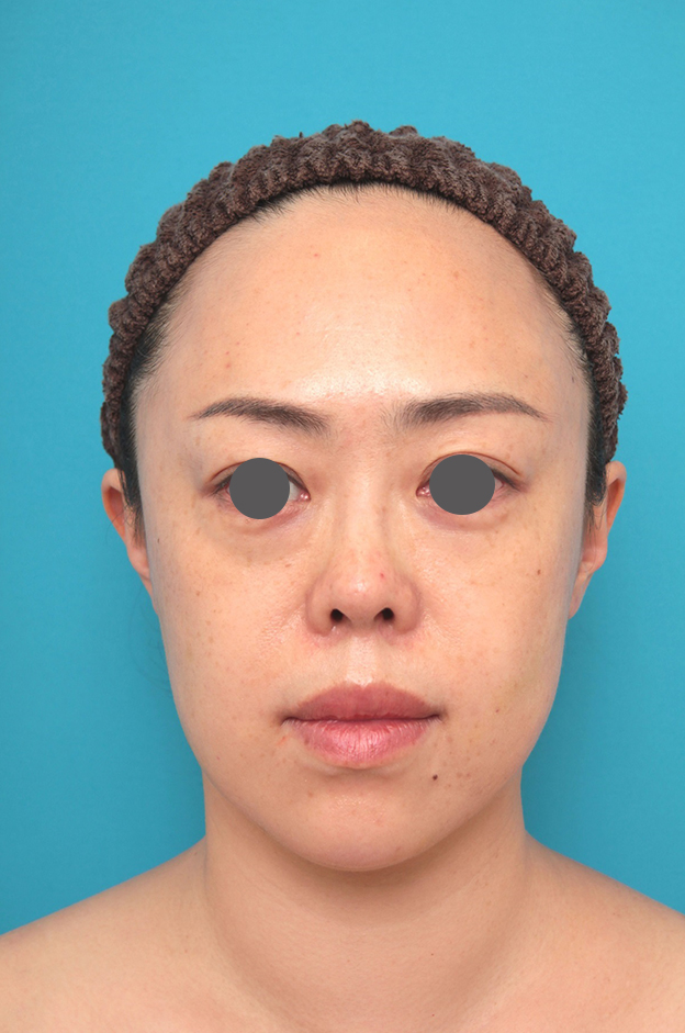 隆鼻術（シリコンプロテーゼ）,鼻プロテーゼ、耳介軟骨移植の症例写真,施術前,mainpic_ryubi1058a.jpg