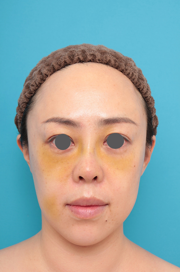 隆鼻術（シリコンプロテーゼ）,鼻プロテーゼ、耳介軟骨移植の症例写真,1週間後,mainpic_ryubi1058b.jpg