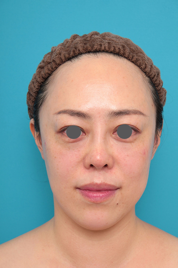 耳介軟骨移植（鼻先を出す）,鼻プロテーゼ、耳介軟骨移植の症例写真,1ヶ月後,mainpic_ryubi1058c.jpg