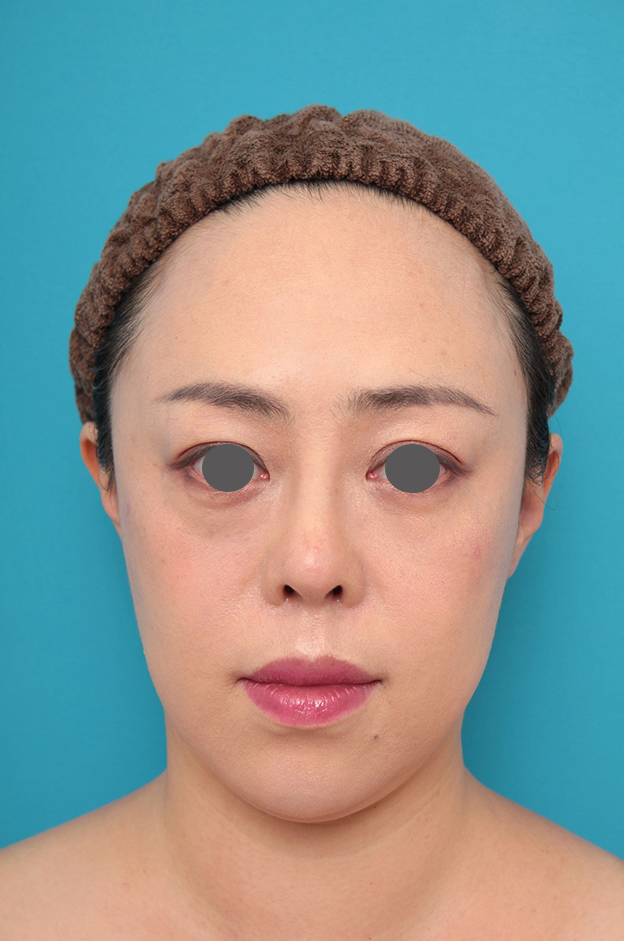 耳介軟骨移植（鼻先を出す）,鼻プロテーゼ、耳介軟骨移植の症例写真,1ヶ月後,mainpic_ryubi1058d.jpg